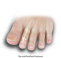 Toe and Forefoot Fractures