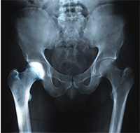 Transient Osteoporosis of the Hip