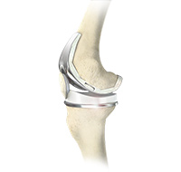 Tricompartmental Knee Replacement