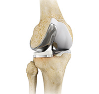 Unicompartmental Knee Replacement