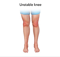 Unstable Knee
