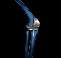 What is new in Knee Replacement